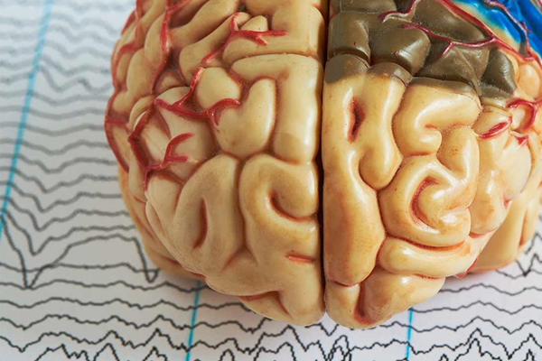 mozg epilepsja padaczka